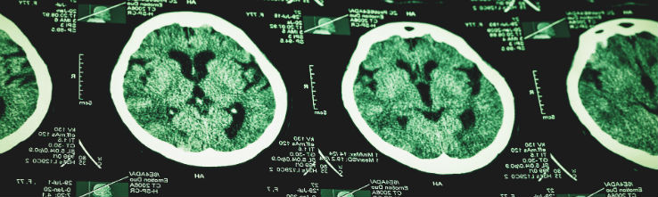 image of brain injury