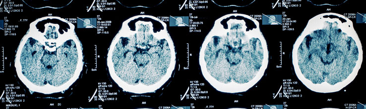 scan of brain injury