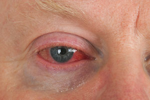 a close up of an injured eye