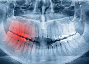 an xray of damaged teeth
