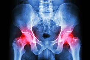 Stryker hip implant recall