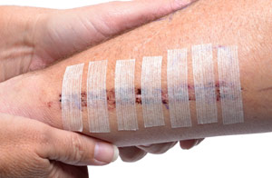 close up of a deep laceration with stitches and bandaids