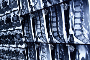 spinal cord injury awareness month