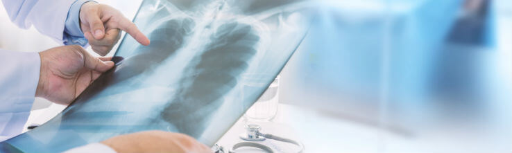 doctors studying picture of lungs