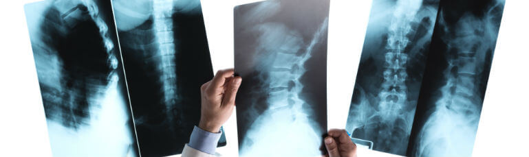 spinal cord x-rays